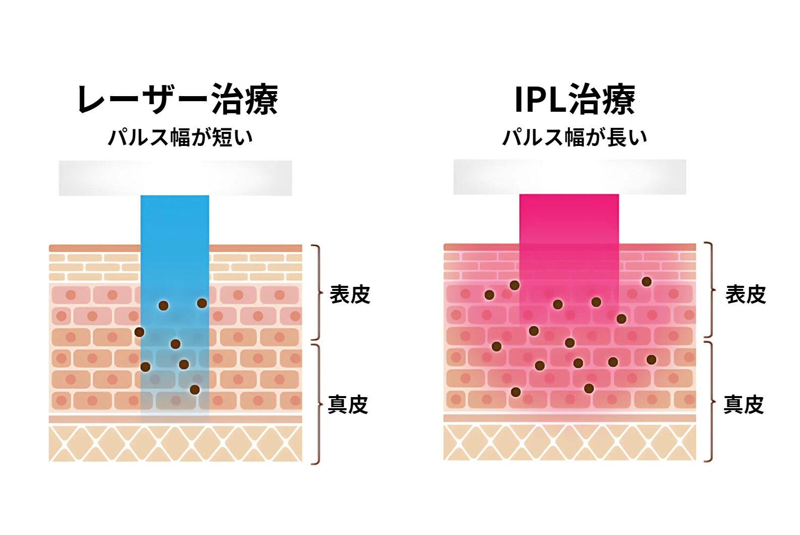 IPL（光治療） | 【公式】青山ハリークリニック