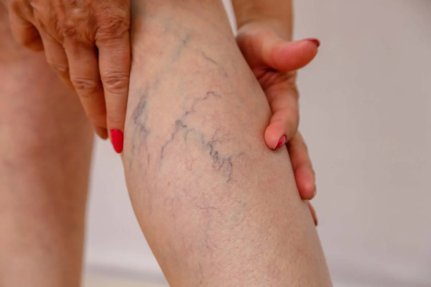 Dermatologists office in Clearwater for Spider Veins treatment