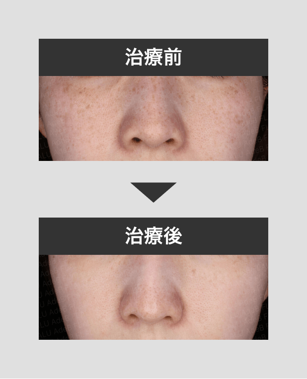 そばかすを消す・取る方法｜レーザー治療と自宅ケア・メイクで隠すコツ