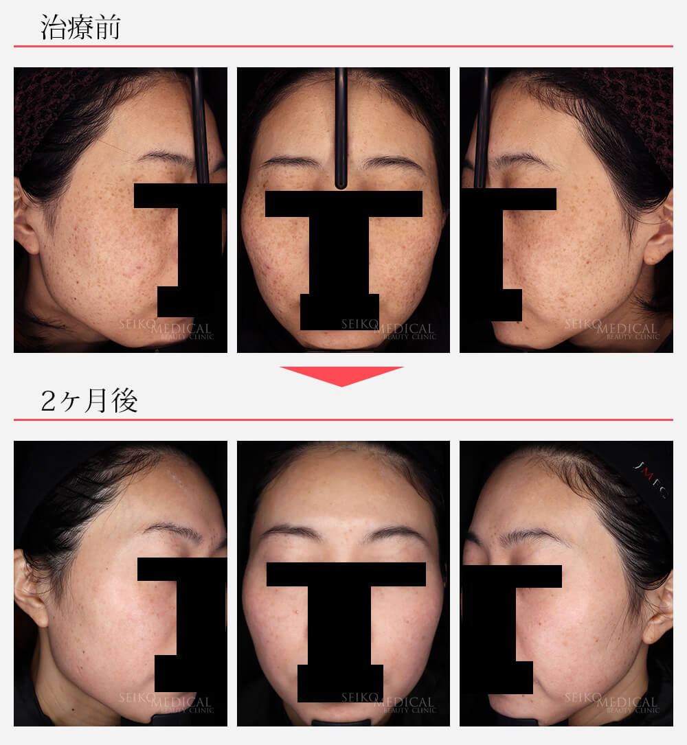そばかす、シミが薄くなり艶々なお肌に♪ | ゼオスキンヘルス｜セイコ